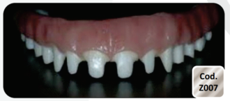 Barra Protocolo em Zircônia com Anatomia Dentaria